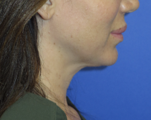 FACEology Lift / Neck Lift