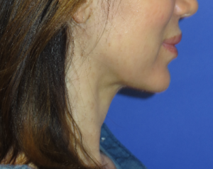FACEology Lift / Neck Lift Case 5745 After Photo FACEology Lift / Neck Lift