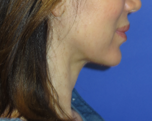 FACEology Lift / Neck Lift