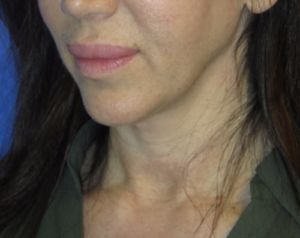 FACEology Lift / Neck Lift Case 5745 Before Photo FACEology Lift / Neck Lift