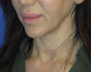 FACEology Lift / Neck Lift