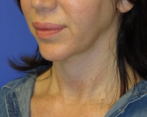 FACEology Lift / Neck Lift Case 5745 After Photo FACEology Lift / Neck Lift