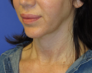 FACEology Lift / Neck Lift