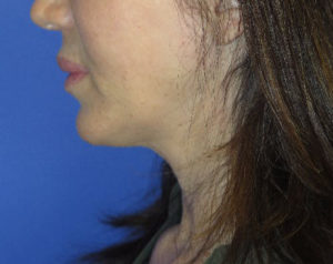 FACEology Lift / Neck Lift Case 5745 Before Photo FACEology Lift / Neck Lift