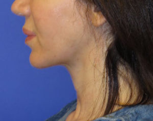 FACEology Lift / Neck Lift Case 5745 After Photo FACEology Lift / Neck Lift