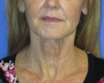 FACEology Lift / Neck Lift