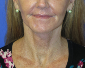 FACEology Lift / Neck Lift Case 5649 After Photo FACEology Lift / Neck Lift