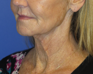 FACEology Lift / Neck Lift Case 5649 Before Photo FACEology Lift / Neck Lift