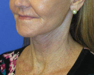 FACEology Lift / Neck Lift Case 5649 After Photo FACEology Lift / Neck Lift