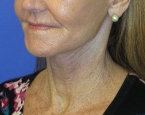 FACEology Lift / Neck Lift