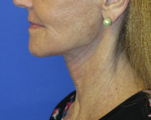 FACEology Lift / Neck Lift Case 5649 After Photo FACEology Lift / Neck Lift