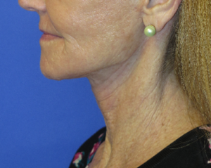 FACEology Lift / Neck Lift