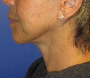 FACEology Lift / Neck Lift Case 5627 After Photo FACEology Lift / Neck Lift