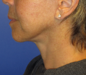 FACEology Lift / Neck Lift