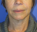 FACEology Lift / Neck Lift