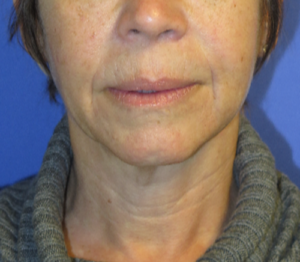 FACEology Lift / Neck Lift Case 5627 Before Photo FACEology Lift / Neck Lift