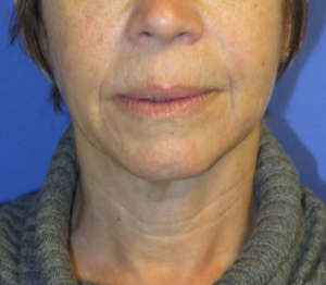 FACEology Lift / Neck Lift