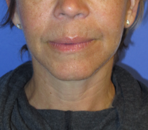 FACEology Lift / Neck Lift Case 5627 After Photo FACEology Lift / Neck Lift