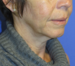 FACEology Lift / Neck Lift