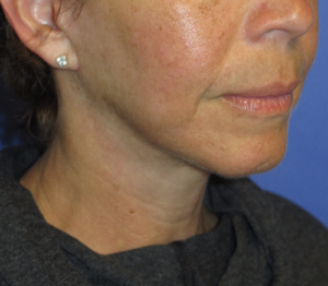 FACEology Lift / Neck Lift Case 5627 After Photo FACEology Lift / Neck Lift
