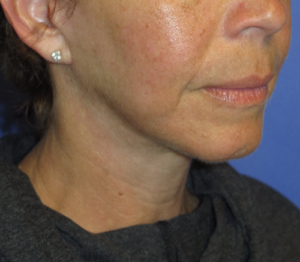 FACEology Lift / Neck Lift