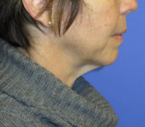 FACEology Lift / Neck Lift Case 5627 Before Photo FACEology Lift / Neck Lift