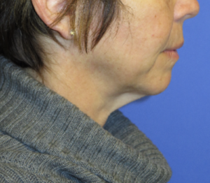 FACEology Lift / Neck Lift