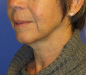FACEology Lift / Neck Lift Case 5627 Before Photo FACEology Lift / Neck Lift
