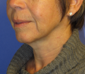 FACEology Lift / Neck Lift