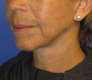 FACEology Lift / Neck Lift Case 5627 After Photo FACEology Lift / Neck Lift