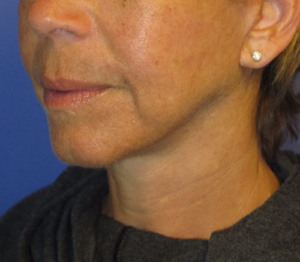 FACEology Lift / Neck Lift