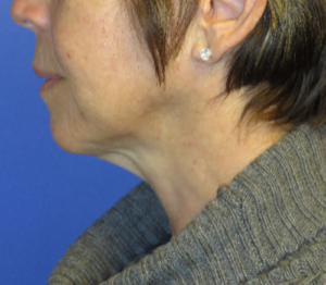 FACEology Lift / Neck Lift Case 5627 Before Photo FACEology Lift / Neck Lift