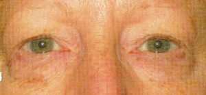 Eyelid Lift Case 5548 Before Photo Eyelid Lift