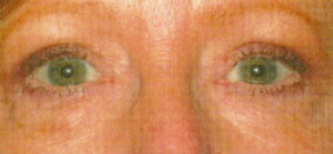 Eyelid Lift Case 5548 After Photo Eyelid Lift