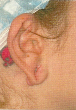Ear Surgery Case 5381 Before Photo Ear Surgery