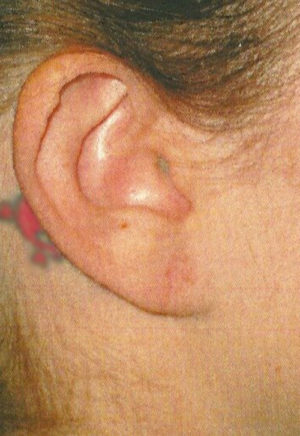 Ear Surgery Case 5381 After Photo Ear Surgery
