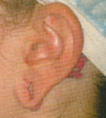 Ear Surgery