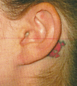 Ear Surgery Case 5381 After Photo Ear Surgery