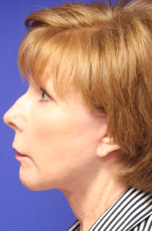 FACEology Lift / Neck Lift Case 5788 After Photo FACEology Lift / Neck Lift