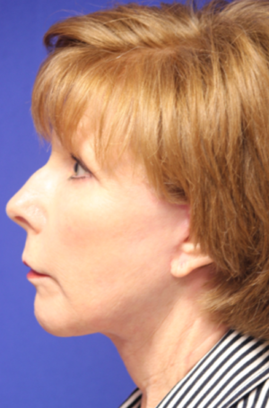 FACEology Lift / Neck Lift