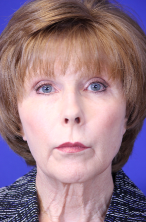FACEology Lift / Neck Lift Case 5788 Before Photo FACEology Lift / Neck Lift