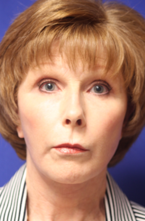 FACEology Lift / Neck Lift Case 5788 After Photo FACEology Lift / Neck Lift