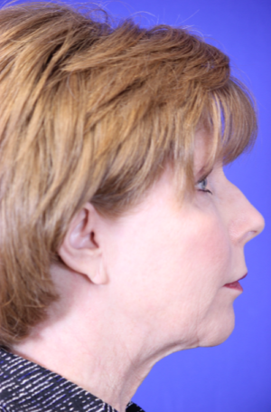 FACEology Lift / Neck Lift Case 5788 Before Photo FACEology Lift / Neck Lift