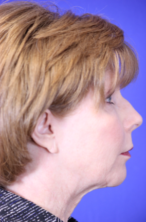 FACEology Lift / Neck Lift