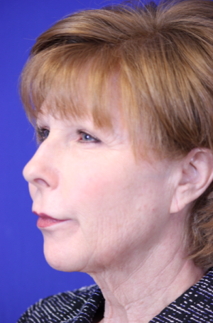 FACEology Lift / Neck Lift Case 5788 Before Photo FACEology Lift / Neck Lift