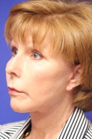 FACEology Lift / Neck Lift Case 5788 After Photo FACEology Lift / Neck Lift