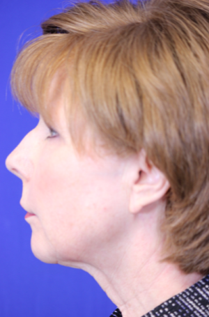 FACEology Lift / Neck Lift Case 5788 Before Photo FACEology Lift / Neck Lift