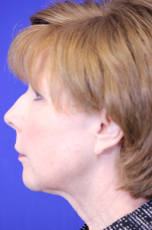 FACEology Lift / Neck Lift