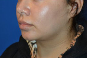 Chin Liposuction Case 5428 Before Photo Chin Liposuction