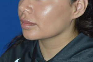 Chin Liposuction Case 5428 After Photo Chin Liposuction
